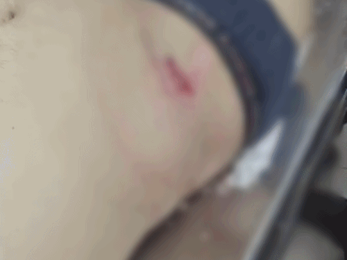 टक्कर के बाद अनिल रौतेला के पेट में गहरी चोट आई।